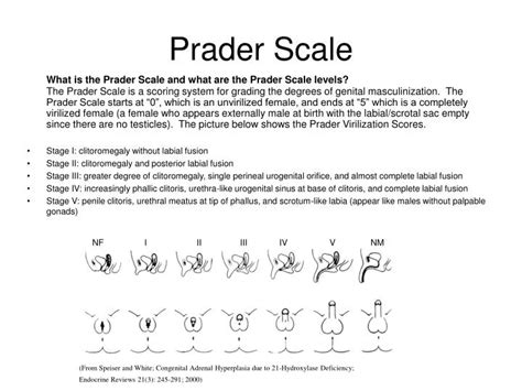 prada scale intersexual|prader scale stage 4.